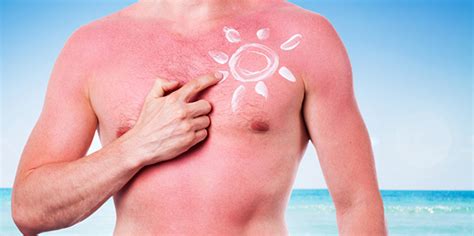 zonneallergie symptomen voorkomen behandeling medicijnen mens en sexiezpicz web porn