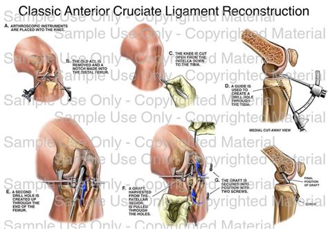 Loading Classic Anterior Cruciate Ligament