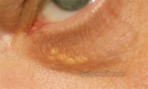 white spots  skin pictures   treatment
