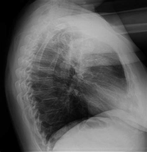 Chest X Ray Left Lateral View Right Anterior