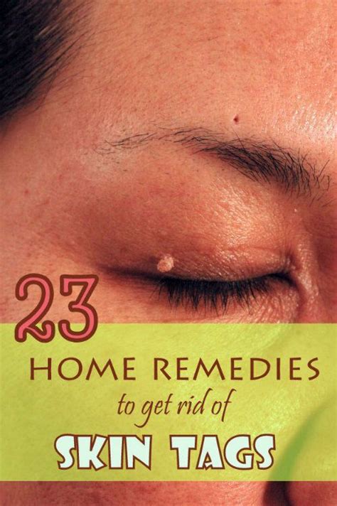 use safe ways to remove skin tags at home get rid of a skin tag from