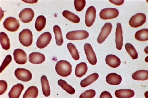 anemia hemolitik ~ informasi kedokteran dan kesehatan
