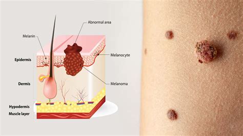 Dermatologists Explain 12 Melanoma Symptoms That Most People Miss
