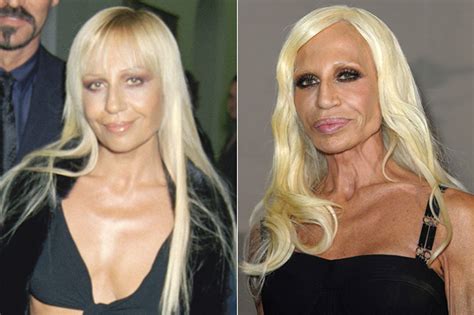 Celebrities Plastic Surgery See Before And After Photos Celebrity