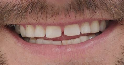 4 methods to close gaps between teeth trusted dental gold coast