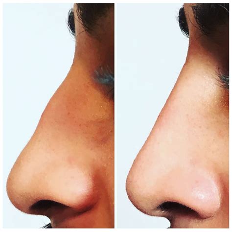 nose reshaping non surgical