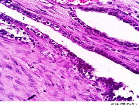 Clear Cell Adenocarcinoma Arising From Abdominal Wall Endometriosis