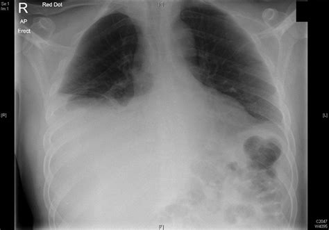Massive Loculated Pleural Effusion In A Patient With Pancreatic