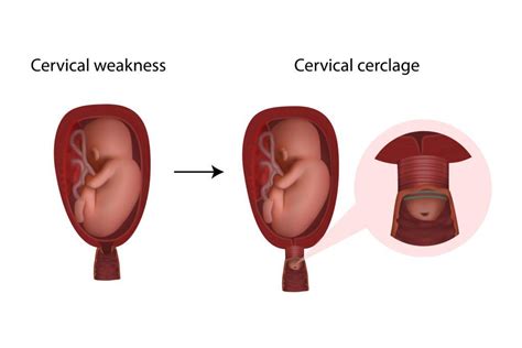 what is a cervical cerclage nabta health