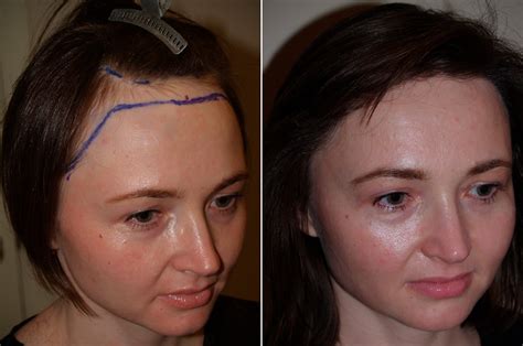 trasplante de pelo en mujeres fotos miami fl paciente 102959