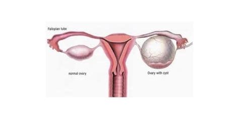 best ovarian cysts surgery hospital and specialist in india rg hospital