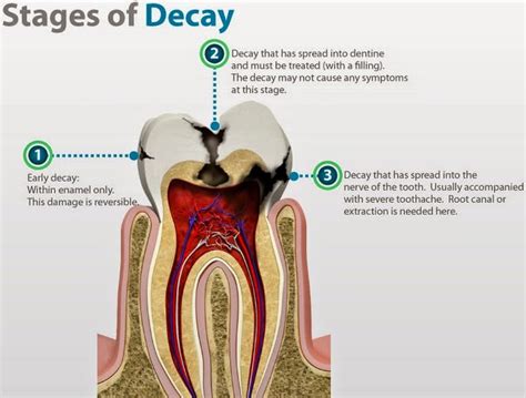 omni dental group dentin decay