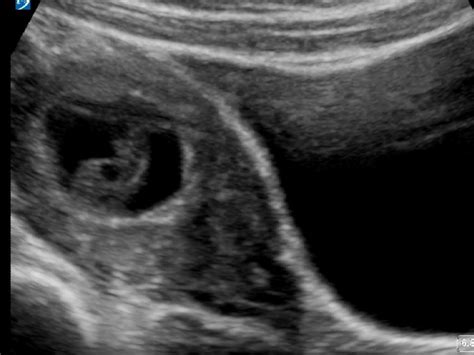 8 weeks missed miscarriage critical care sonography