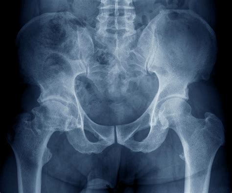 osteoarthritis   hip photograph  zephyrscience photo library fine art america