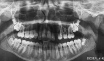 casus transpositie cuspidaat premolaar bij een meisje van  dentalinfo