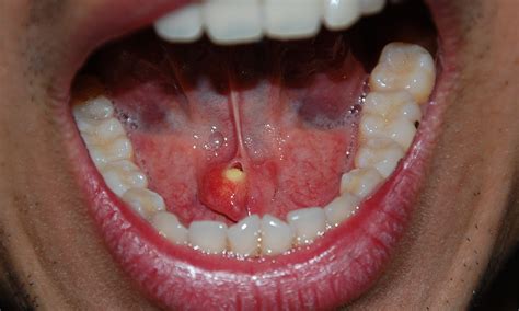 bump  tongue   caused   disease vibonaci