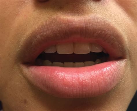 small white spots   lips mdedge dermatology