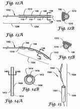 Patents Brachytherapy sketch template