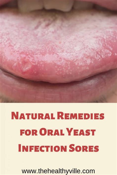 Yeast Infection Big Mouth Causes Symptoms And Treatments Martlabpro