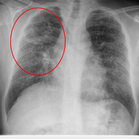 Chest Radiograph Showing Right Upper Lobe Cavitary Lung Lesion And