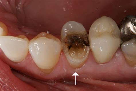 gallery  chipped tooth repair molar