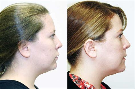 jaw  chin  corrective jaw surgery dr antipov
