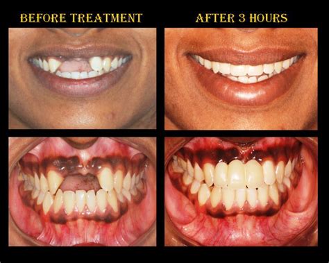 front tooth replacement  basal implants