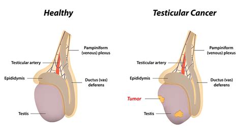 Testicular Cancer Urology Specialists Nc