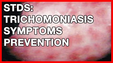 stds trichomoniasis symptoms prevention and treatment youtube