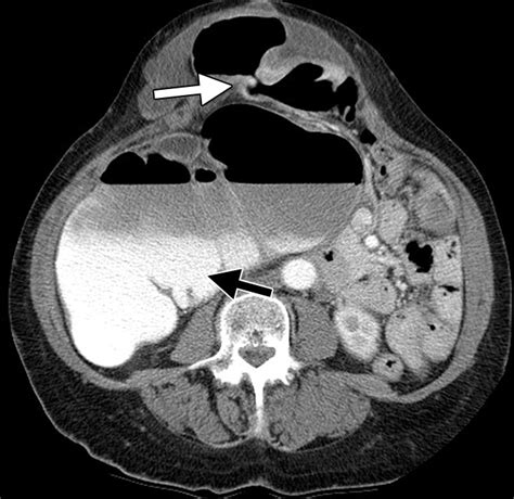 large bowel obstruction   adult classic radiographic  ct