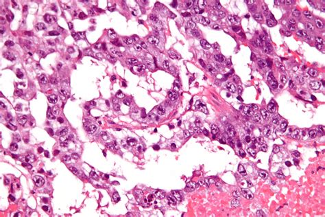 filemixed germ cell tumour  high magjpg wikimedia commons
