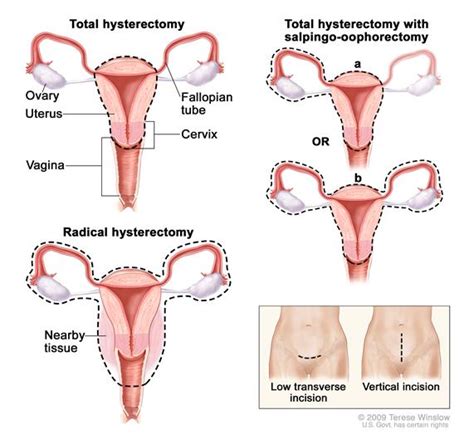 uterine sarcoma