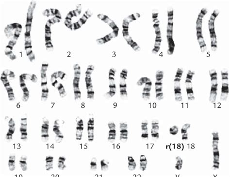 A Karyotype Of 46 Xy R 18 P11 21q21 2 Download Scientific Diagram