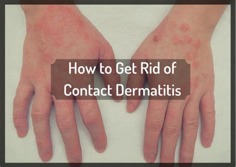 rid  itchy contact dermatitis  natural  remedygrove