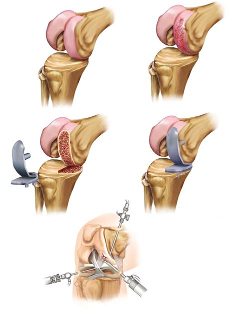 Partial Knee Replacement Hip Knee And Foot Orthopaedic