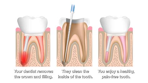 long   root canal  nashville tn gulch dental studio