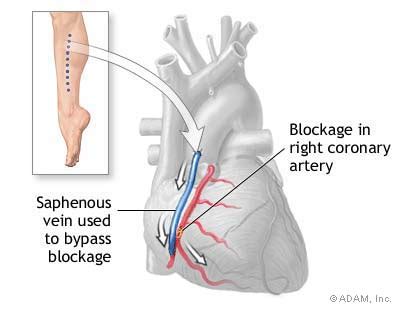york times health  show heart bypass surgery