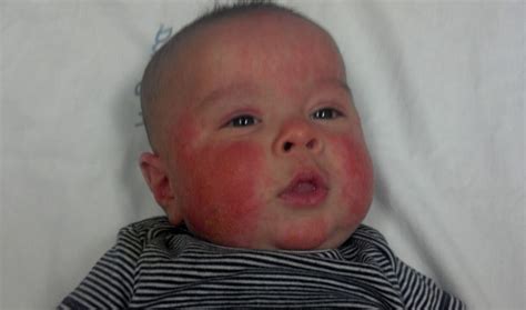 baby  red cheeks  cures remedies skincarederm