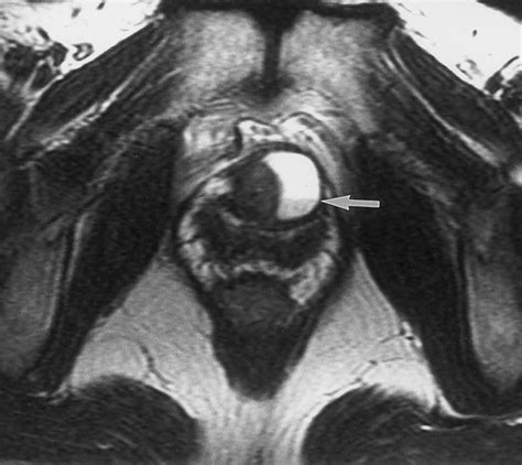 mr imaging of the male and female urethra radiographics