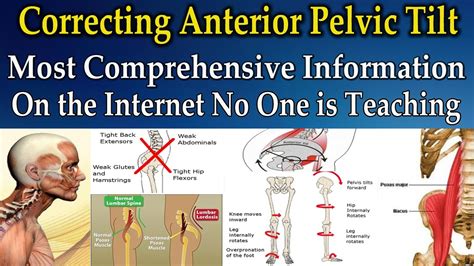 Correcting Anterior Pelvic Tilt Best Information On The