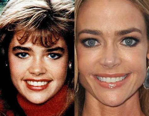 Denise Richards Plastic Surgery Boobs Boob Job Nose Job