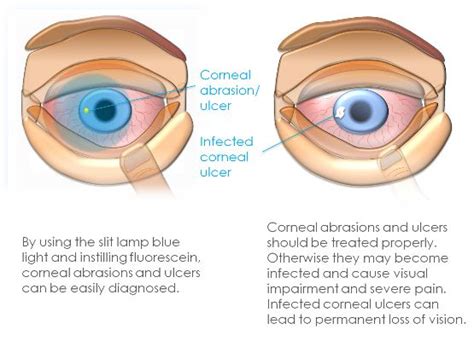 Corneal Abrasion And Ulcer Clinica London