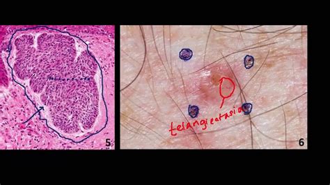 introduction  nmsc skin cancer  basal cell cancer bcc  squamous cell cancer scc