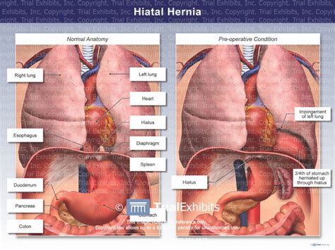 Hiatal Hernia Comparison Anatomy Trialexhibits Inc