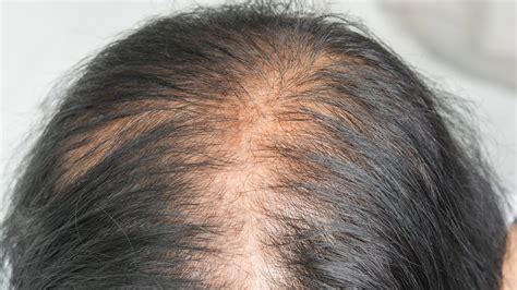 female pattern baldness  treatments   goodrx