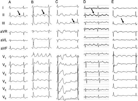 Characteristics Of Cavotricuspid Isthmus–dependent Atrial Flutter After