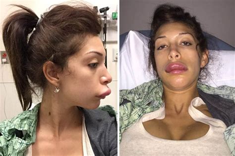 The Most Shocking Celebrity Plastic Surgery Failures Daily Star