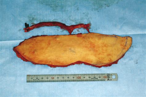 appearance   harvested anterolateral thigh flap