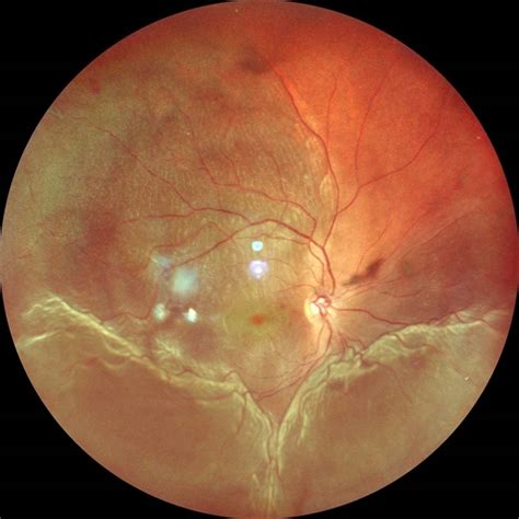 retinal detachment retina image bank