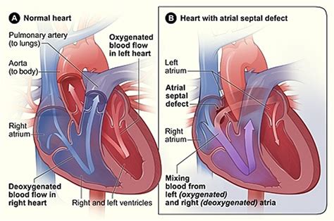congenital heart disease types   symptoms
